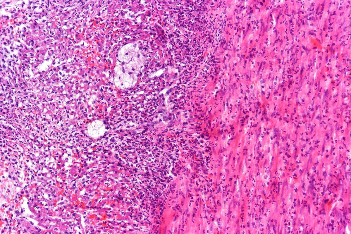 Characterization of epizootiology and clinical features of strangles in horses